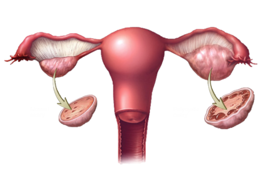 PCOS Affects Every 1-in-10 Women, Are You the 1 (2)